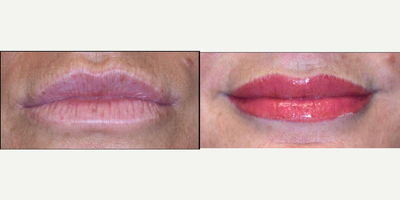 Lip Tattooing - Cosmetic tattooing is a procedure that tattoos pigment onto areas of the face that mimics the appearance of makeup. Cosmetic tattoos are used by people who have sensitivity or allergies to traditional cosmetics, people with difficulty seeing, and patients who are unable to apply makeup due to conditions like arthritis or Parkinsons disease. In addition, it is also beneficial for those who do not have facial hair due to allergies, hair pulling, or aging and genetics. After the areas of the face receive cosmetic tattoos, the makeup becomes semi-permanent and will not wash off from water, cleansers, or sweat. Cosmetic Tattooing is usually applied to the eyebrows, upper and lower eyelashes, and the lips.