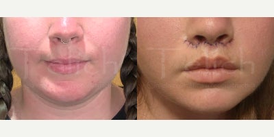 25-34 year old woman treated with Lip Lift, Lip Surgery - 25 year old woman who underwent lip lift under local anesthesia