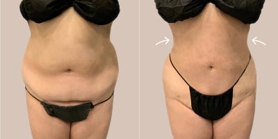 25-34 year old woman treated with AirSculpt - This patient received Stomach AirSculpt fat removal. Procedure was done in our Beverly Hills location and results are only 3 months post-op.