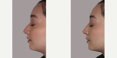 Woman treated with Nonsurgical Nose Job - She decided to have a non-surgical rhinoplasty and have immediate and pain-free results!