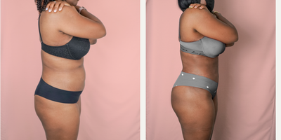 35-44 year old woman treated with Brazilian Butt Lift - This is a lovely patient underwent a 360 Liposuction and BBL, where fat was transferred to her buttocks and hips. She is shown 2 months post-op.