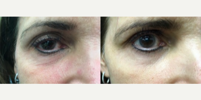 Woman treated with Microneedling RF - One Agnes RF Treatment, 4 months post-op