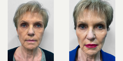 65-74 year old woman treated with Lip Fillers, Dermal Fillers, Chin Filler - This woman in her mid-sixties was interested in enhancing her smile with lip filler.  Heather, our nurse injector, also recommended filler to her chin and mid face to help balance her appearance and she looks great.