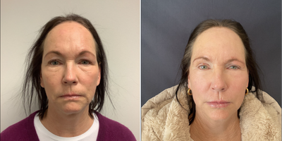 55-64 year old woman treated with Double Eyelid Surgery, CO2 Laser - 55-64 year old woman treated with Double Eyelid Surgery, CO2 Laser.