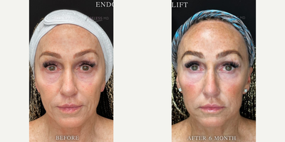 55-64 year old woman treated with Skin Tightening - Endolift for the Face and Neck