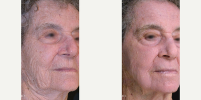 65-74 year old man treated with TotalFX - DeepFX to peri-oral + peri-orbital, ActiveFX to full-face