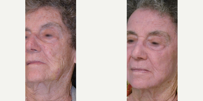 65-74 year old man treated with TotalFX - DeepFX to peri-oral + peri-orbital, ActiveFX to full-face
