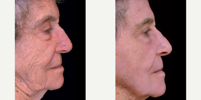 65-74 year old man treated with TotalFX - DeepFX to peri-oral + peri-orbital, ActiveFX to full-face
