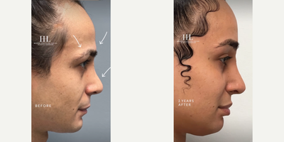 Woman treated with Septoplasty - Woman treated with Type 3 Brow Bone Reconstruction, Brow Lift, and Septoplasty (Septorhinoplasty) to correct the crooked nose. Patient is shown before and 2 years post-op.