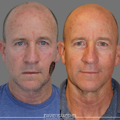 45-54 year old man treated with Facial Reconstructive Surgery, Mohs Surgery - Patient was referred by his Dermatologist for reconstruction of this mohs defect after removal of a melanoma, underwent facial reconstruction achieving a closure without large scars across his face or neck and without asymmetry and malposition of the lower eyelid, nasolabial fold, sideburn, and earlobe. This can be an emotional period for patients and Im grateful to help.