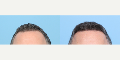 45-54 year old man treated with FUE Hair Transplant, Hair Transplant, Hair Loss Treatment - Dr. Wise performed an FUE hair transplant on this 46-year-old patient to fill in sparse areas and add density.