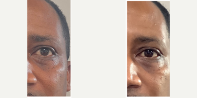 45-54 year old man treated with Opus Plasma - 1 treatment of Opus Plasma Skin Resurfacing around the eyes