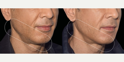 Man treated with Emface - Man treated with Emface