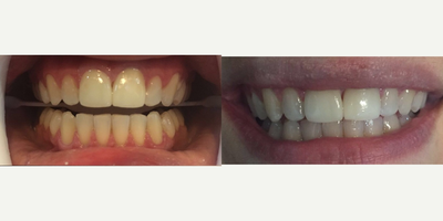 25-34 year old woman treated with Zoom Whitening - Glo whitening which is realized in the clinic and takes just 40 minutes to get you teeth whitened. It gives zero pain sensibility on patients  99% of the cases.