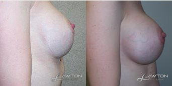 Breast Implant Revision - Age: 28 Height: 55 Weight (lbs): 110 Volume (cc): 550 Pre/Post: 34C/34C Follow Up (months): 6