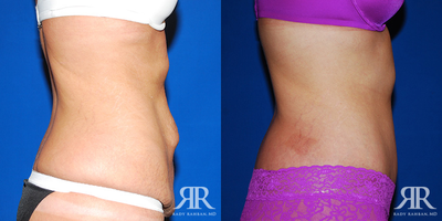 Tummy Tuck - Tummy Tuck