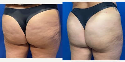 55-64 year old woman treated with Qwo - 55 year old female shown 6 weeks after her 3rd treatment with QWO to treat buttock cellulite/dimples.