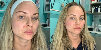 35-44 year old woman treated with Vivace - Vivace RF Fractional Microneedling treatment. Focus on small scars on cheeks, crows feet and techneck lines.