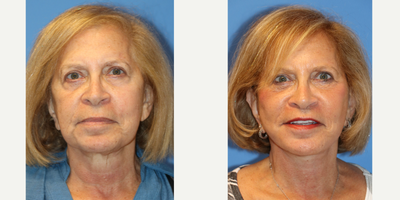 65-74 year old woman treated with Facelift, Facelift Revision, Neck Lift - This is a 74 year old female presented for a revision facelift. The patient had undergone facelift 23 years ago. She has recurrent skin laxity of the face and neck, squaring off of the face due to jowling and descent of soft tissue. Dr. Lipschitz performed revision face and neck lift with platysmaplasty and plication of the SMAS. Before and 3 months post op results