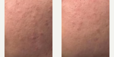 Woman treated with DiamondGlow - Results shown are over 1-6 treatments.