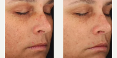 Woman treated with DiamondGlow - Results shown are over 1-6 treatments.