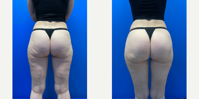35-44 year old woman treated with Subcision, Skin Tightening - 43 year-old woman having cellulite treatment with Aveli. This device cuts the septa that cause the dimples of cellulite. This treatment is permanent and leads to long-term permanent cellulite reduction.