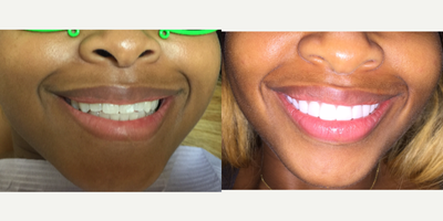 18-24 year old model treated with ten Porcelain Veneers - Dr. Sarah Thompson veneered this patient's top ten teeth in just two appointments.&nbsp;She was already attractive before her veneers, but the veneers have significantly enhanced her beauty. She can expect her veneers to last her decades without ever having to whiten them.
