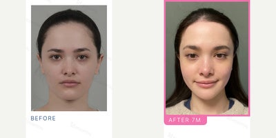 25-34 year old woman treated with V Line Surgery, Rhinoplasty - LA, Rh