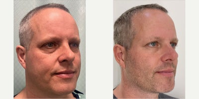 55-64 year old man treated with Eyelid Surgery - Lower blepharoplasty, fat transposition, skin pinch + TCA butterfly peel.