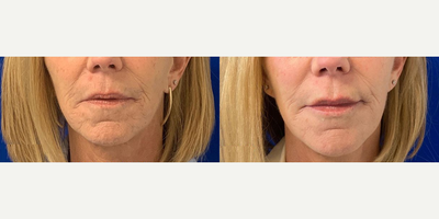 55-64 year old woman treated with Microneedling - Our 59 year old patient was treated with PRP and Microneedling over the course of 6 months to address fine lines and wrinkles and improve the overall quality of her skin