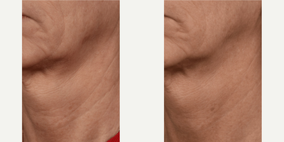 Woman treated with SkinPen - Woman treated with SkinPen Microneedling for facial and neck wrinkles