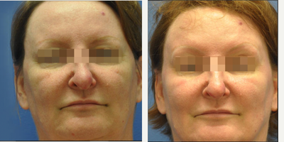 Woman treated with SmartSkin CO2 laser - Woman treated with SmartSkin CO2 laser