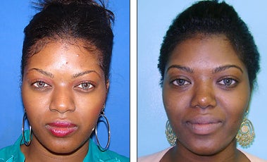 Nose Job- Rhinoplasty -
Before and After Nose Job/ Rhinoplasty