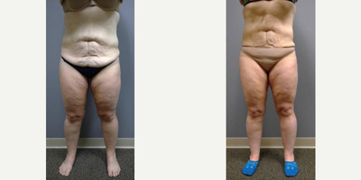 40 year old woman treated with UltraShape Power - 40 year old woman treated with 3 sessions of UltraShape Power