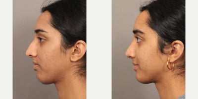 18-24 year old woman treated with Rhinoplasty with an Alarplasty (Nostril Reduction) - Dr. Lexie Wang performed a Rhinoplasty with an Alarplasty (Nostril Reduction). The patient is 4 months post-op.