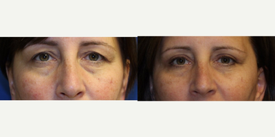 45-54 year old woman treated with Eyelid Surgery - Cosmetic upper and lower blepharoplasty with Dr. Kim. Lower eye blepharoplasty was performed via transconjunctival approach (no external incision) with fat repositioning.