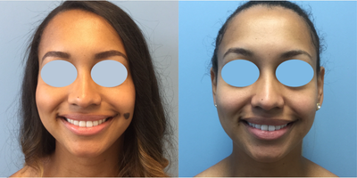 25-34 year old woman treated with Mole Removal - Patient desired removal of her left cheek mole and was treated by surgical excision.  The patient is not wearing makeup in her photos