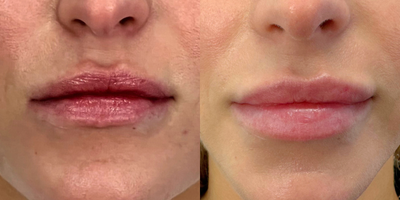 18-24 year old woman treated with Restylane Contour, Lip Fillers - This patient needed a full lip rehab. The top of her lip had severe migration and unevenness. She had two Hylanex treatments before she was treated with a 1 syringe of Restylane Contour.