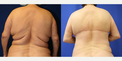 45-54 year old woman treated with Back Lift - This patient was unhappy with her back rolls after losing a significant amount of weight. She desired a flat back. Dr. Katzen was able to remove excess skin and fat of her back by performing an upper body lift (also known as a horizontal torsoplasty). She loves her results.