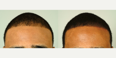 35-44 year old man treated with Scalp Micropigmentation - 35 year old man with frontal thinning after three sessions of SMP.