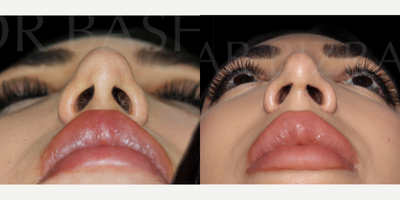 Woman treated with Sinus Surgery - Blocked Nose