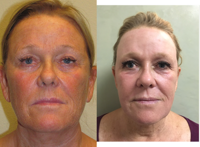 45-54 year old woman treated with Age Spots Treatment - S/p J-Plasma Facial Resurfacing