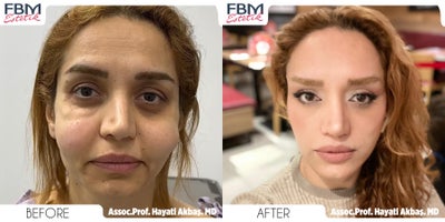 35-44 year old woman treated with Deep Plane Facelift, Buccal Fat Removal, Facial Fat Transfer - permanent filler removal and DP face lift conducted all at the same time, Fat injection awas lso applied to enhance the skin and volume in the face .