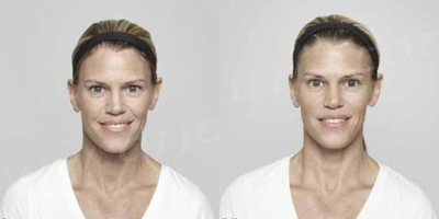 Woman treated with Restylane - Restylane-L: 2.0cc to Nasolabial Folds and Upper Lip. Dysport: 50 units to Glabella.