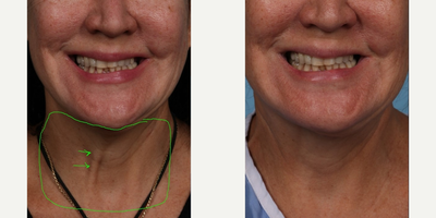 55-64 year old woman treated with Fraxel Laser, Fraxel Repair, Skin Tightening, Skin Rejuvenation, Laser Resurfacing, CO2 Laser, - Our 56 year old patient was so happy with her 5 month post operative results after her blepharoplasty & endoscopic browlift with Fraxel Repair CO2 laser of her face and neck that she wanted to share her 2nd Fraxel Repair treatment with you today.In the future, her plans are for an extended deep plane facelift.  For now the Fraxel Re:pair has given her really nice skin tightening.  A 2nd treatment today with topical PRP will only add to her results. She also had her toxin treatment to relax her right platysmal band.There is a little oozing for 2 days and then skin redness for one week at which makeup can be used to cover up the light pink color that persists up to 3 months.  Patients who want no downtime can opt for fractionated microneedling such as our Genius treatments.