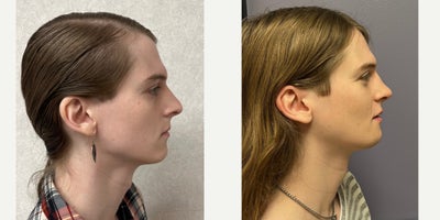 25-34 year old woman treated with Septoplasty, Revision Rhinoplasty, Facial Feminization Surgery, Adam's Apple Reduction - This young lady underwent septorhinoplasty, chondrolaryngoplasty, mandible/chin feminization.
