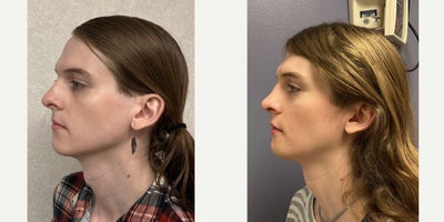 25-34 year old woman treated with Septoplasty, Revision Rhinoplasty, Facial Feminization Surgery, Adam's Apple Reduction - This young lady underwent septorhinoplasty, chondrolaryngoplasty, mandible/chin feminization.