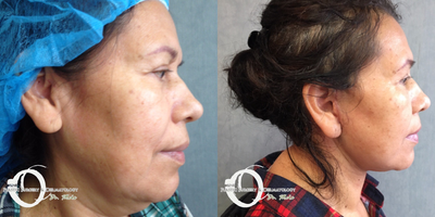 45-54 year old woman treated with Lower Face Lift - full face and neck lift .... no sutures outside