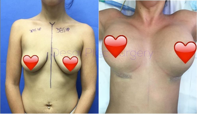 Woman treated with Breast Augmentation - 3855cc HP Profile Gummy Bear, Implants, Dual Plane Technique.