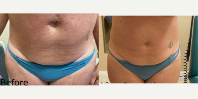 35-44 year old woman treated with truSculpt - 35-44 year old woman treated with truSculpt